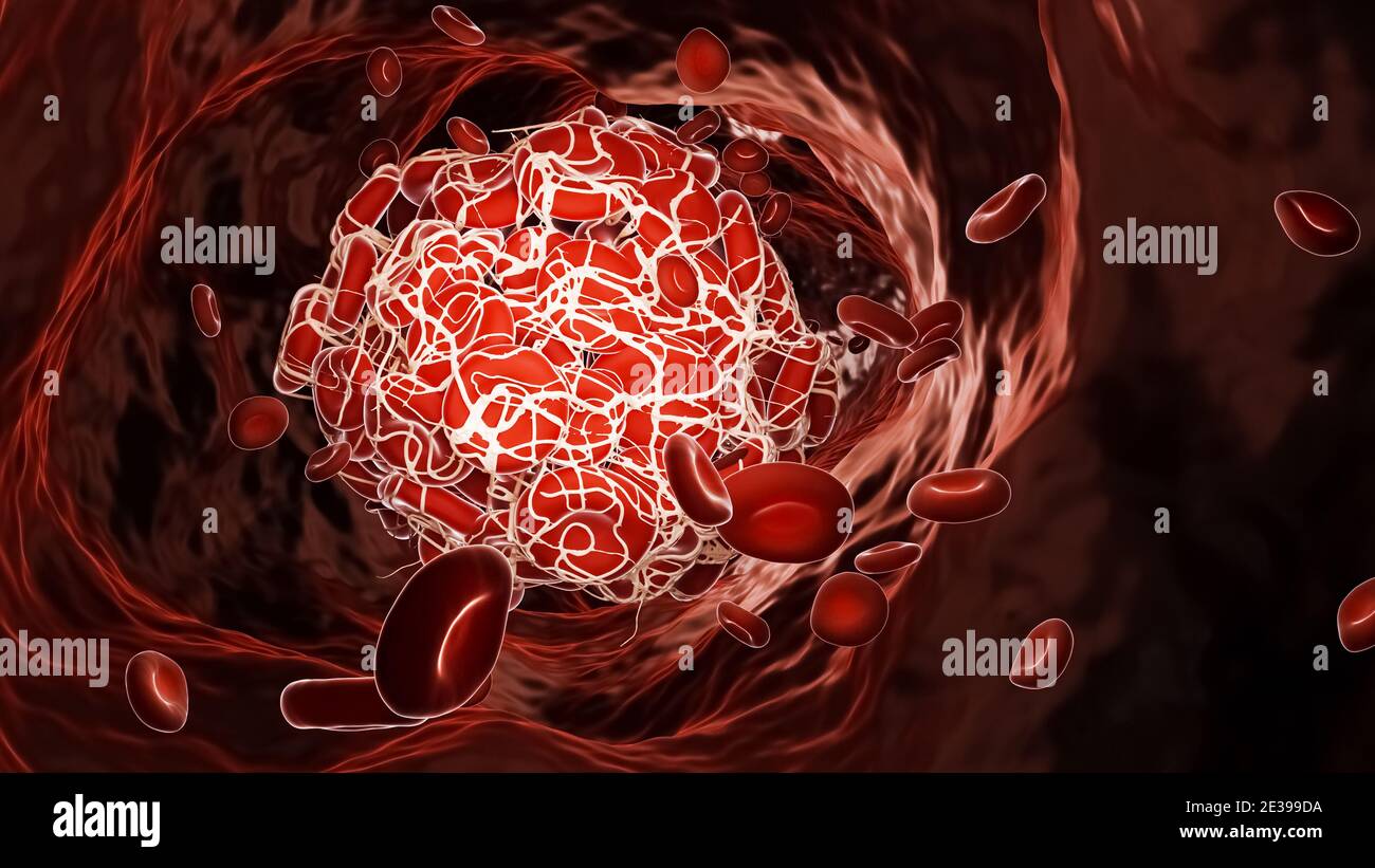 Thrombus oder Blutgerinnsel in einem Blutgefäß fließt mit roten Blutkörperchen 3D Rendering Illustration. Venenthrombose, Herz-Kreislauf-Erkrankungen, Medizin, Stockfoto