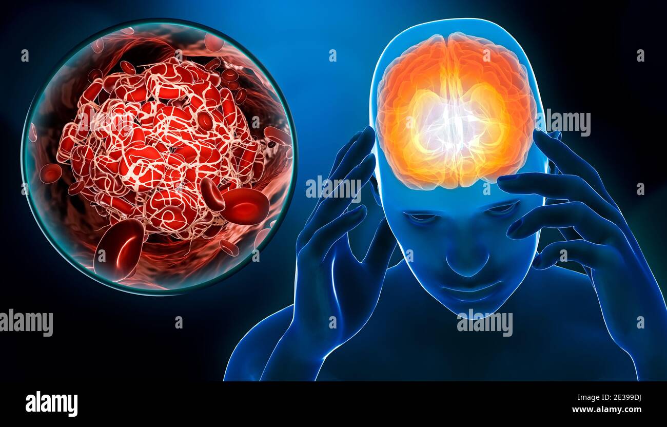 Mann, der an einem zerebrovaskulären Unfall oder Schlaganfall oder Hirnanfall mit Blutgerinnsel oder Thrombus leidet 3D-Rendering-Illustration. Medizin, medizinische Patholo Stockfoto