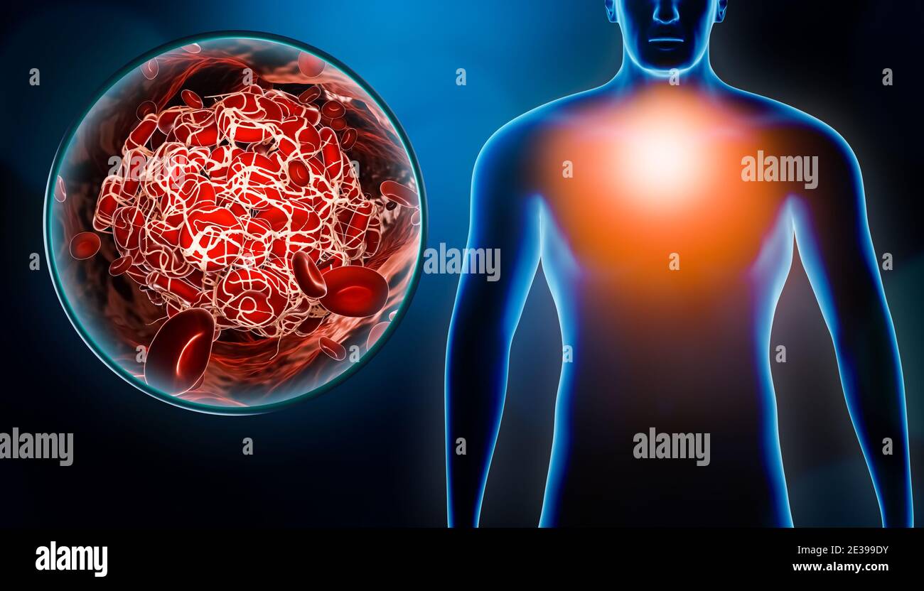 Mann leidet Brustschmerzen aufgrund von Embolie oder Embolie mit Blutgerinnsel oder Thrombus Bild 3D-Rendering Illustration. Medizin, Krankheit, Gesundheit, Stockfoto