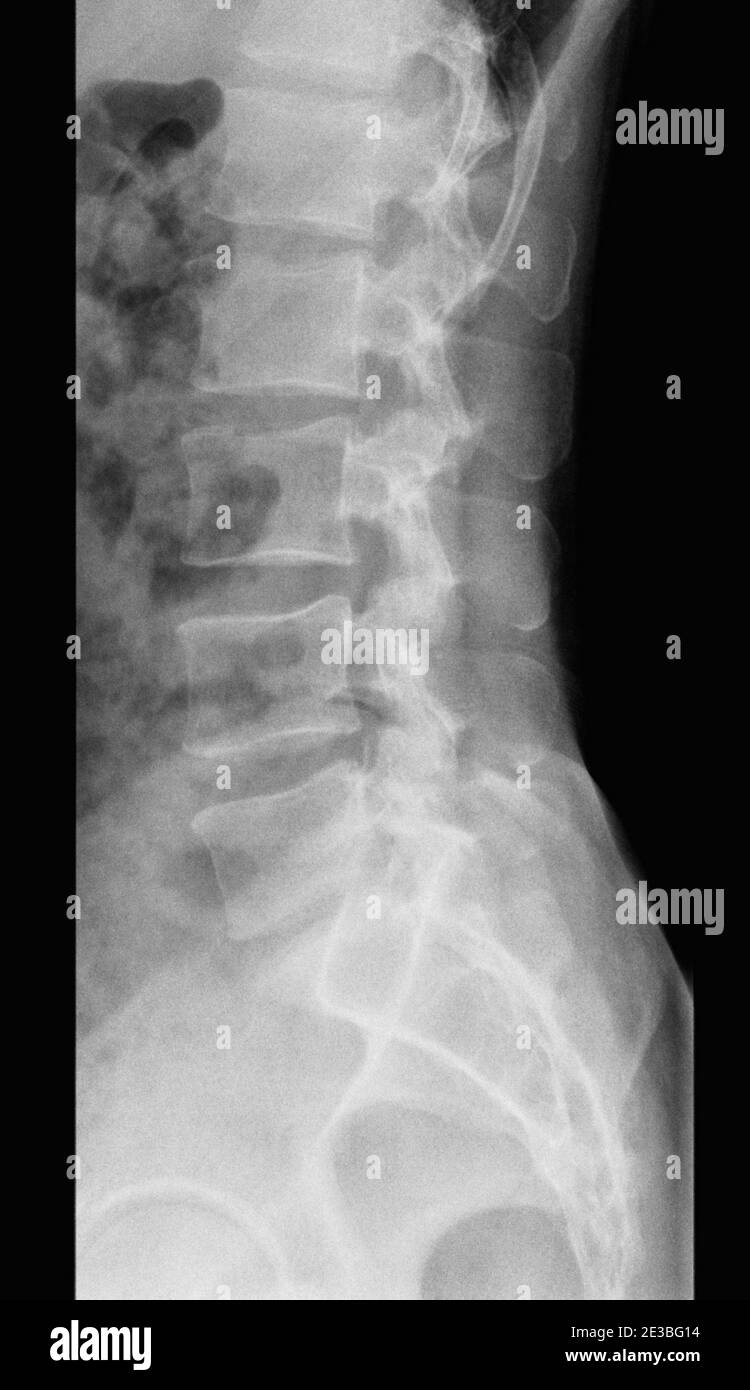 Röntgenaufnahme der menschlichen Lendenwirbelsäule - Erwachsener, Seitenansicht Stockfoto