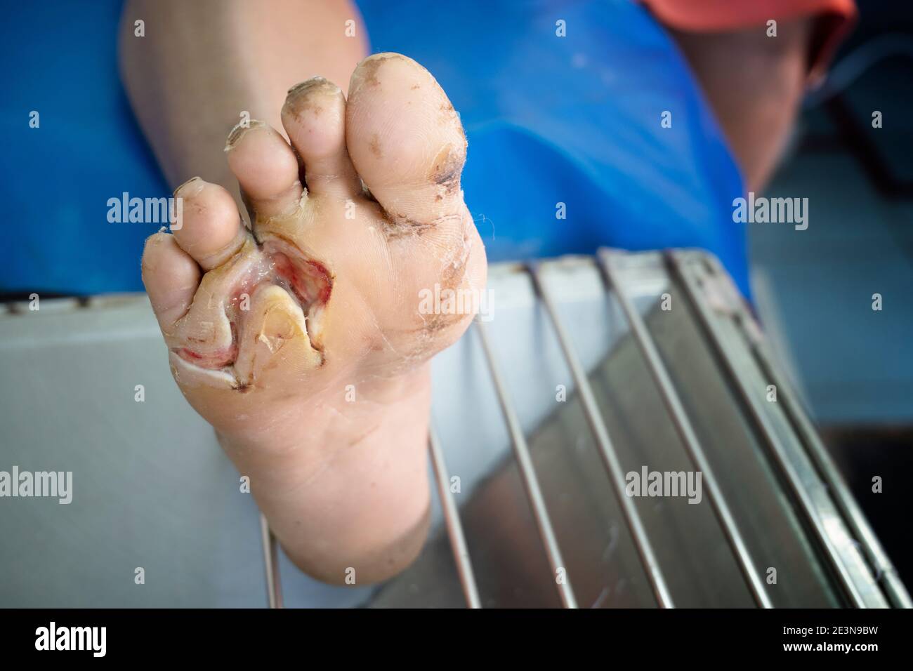 Infizierte Wunde des diabetischen Fußes, Gesundheitskonzept Stockfoto