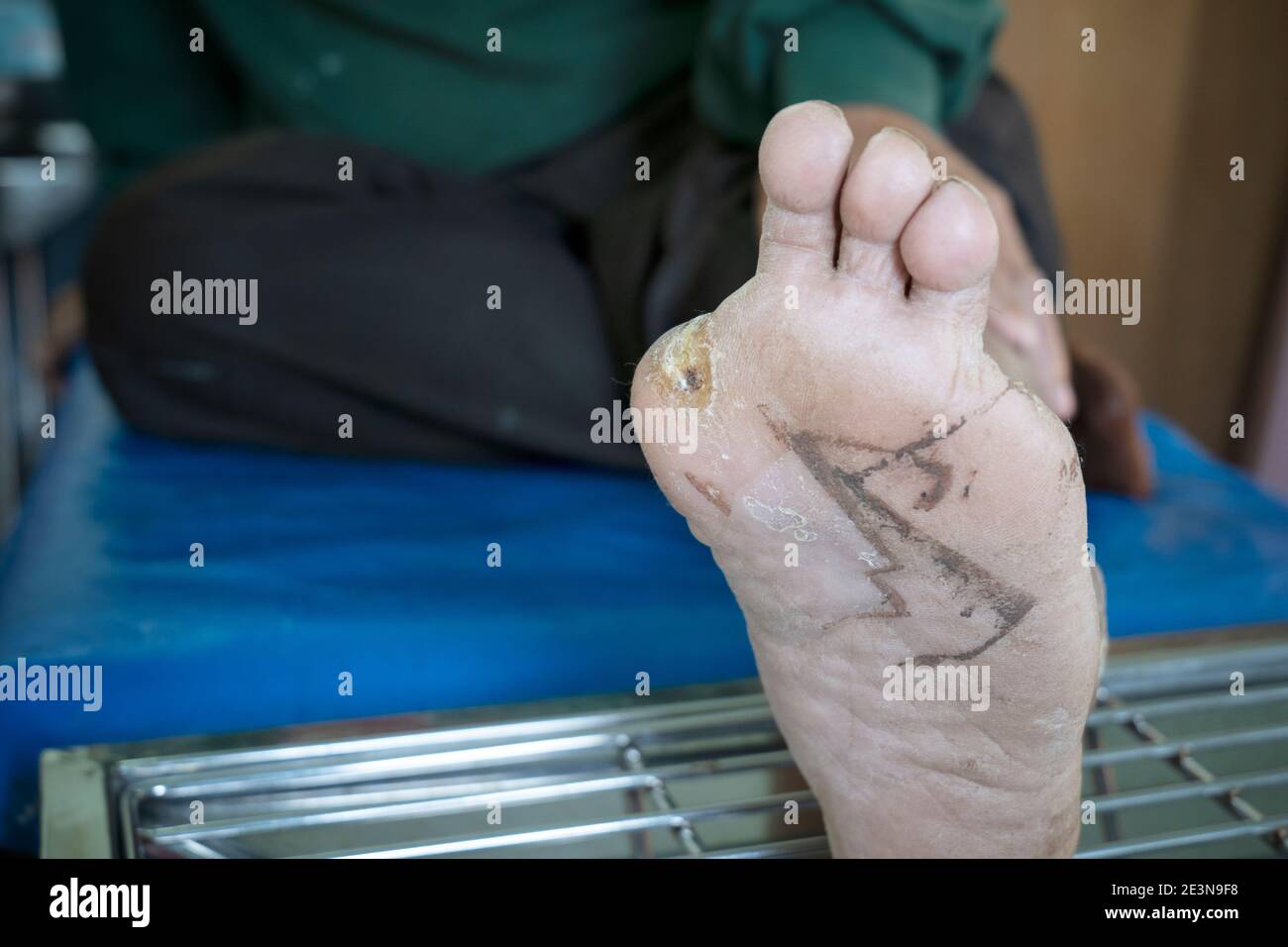 Infizierte Wunde des diabetischen Fußes, Gesundheitskonzept Stockfoto