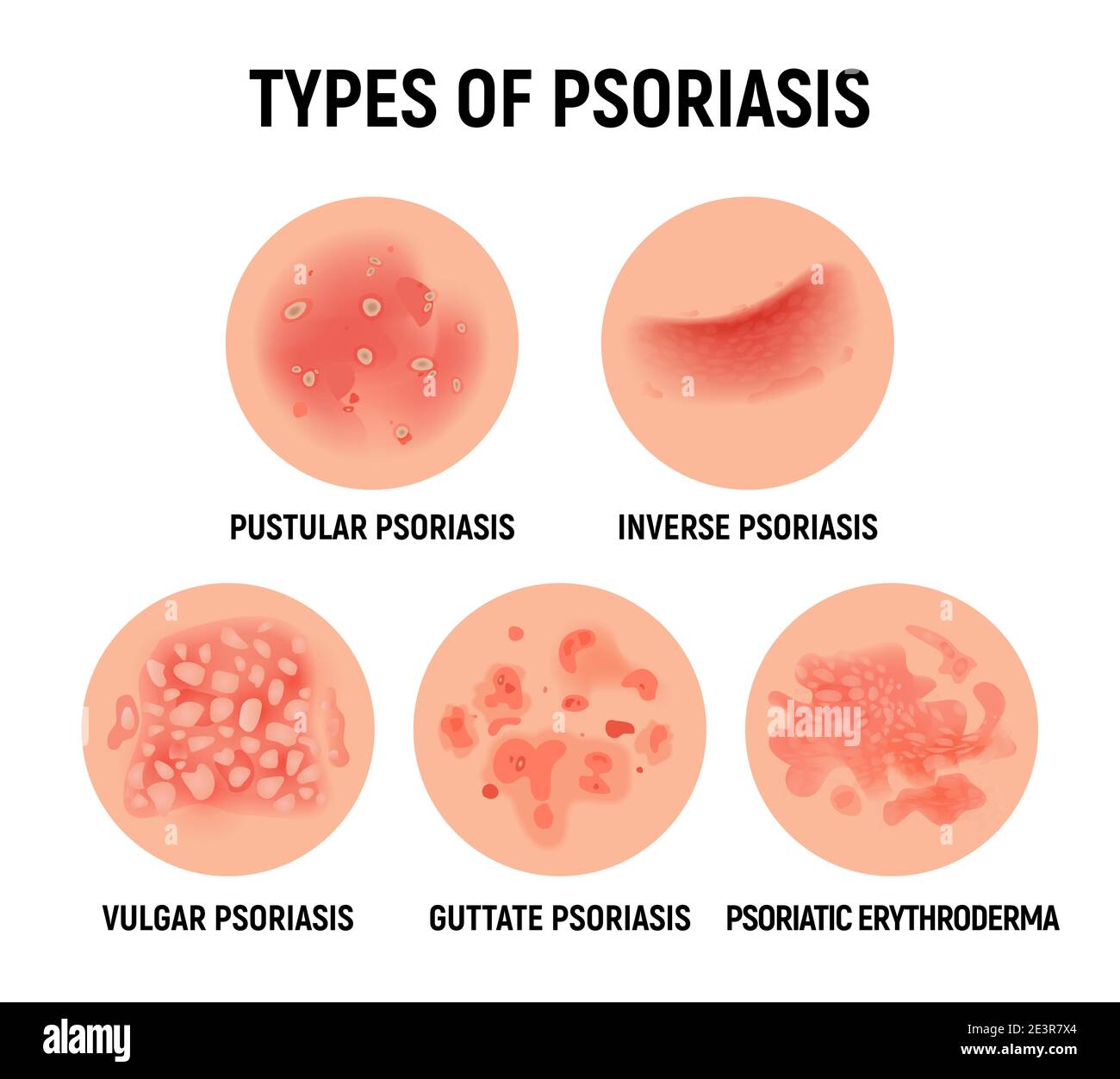 Psoriasis Ausschlag Vektor Haut Hand Infektion Hintergrund. Psoriasis