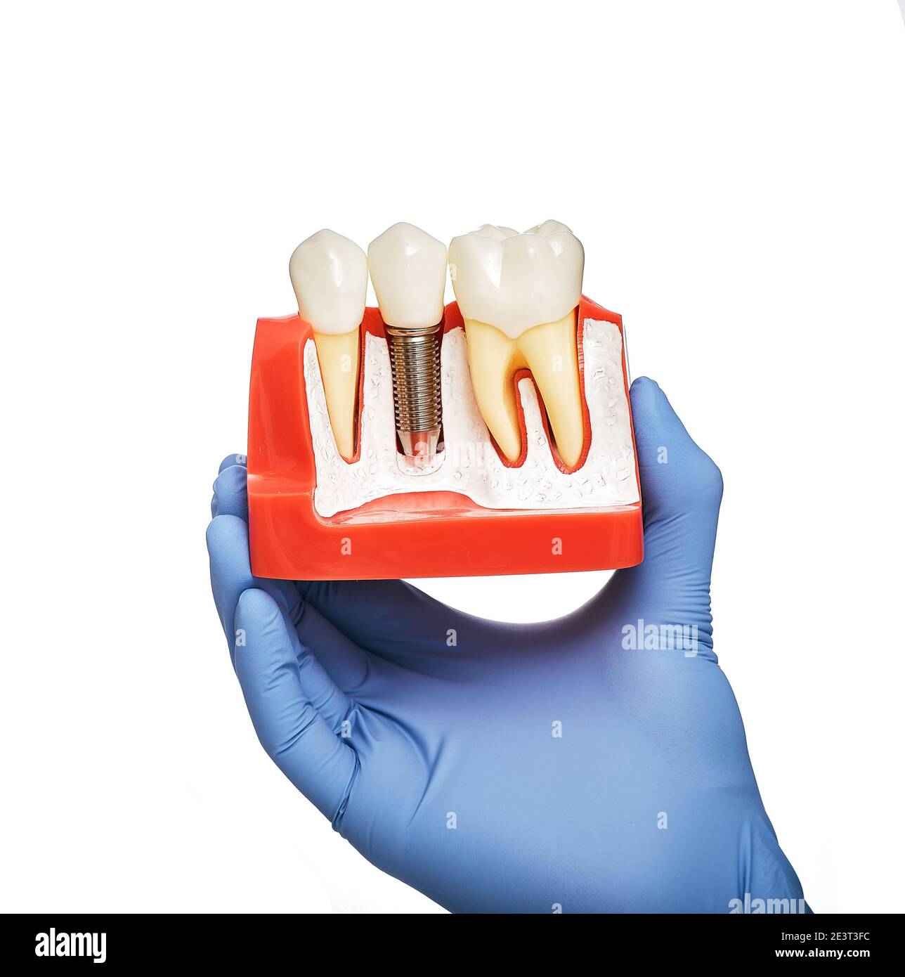 Zahnarzt hält ein anatomisches Modell der Zähne mit einem Zahnimplantat in der Hand, Nahaufnahme. Zahnprothetik Konzept, weißer Hintergrund Stockfoto