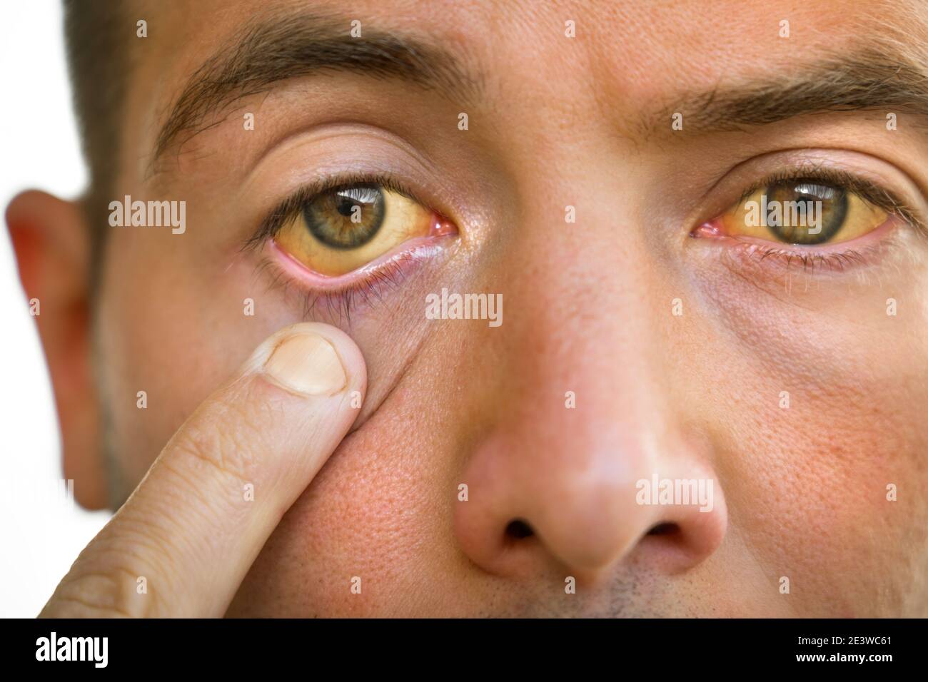 Junger Mann mit gelblichen Augen und Haut. Gelbsucht, Lebererkrankung Stockfoto