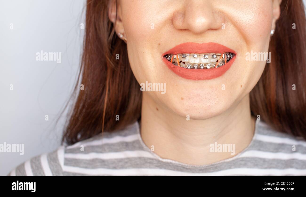 Zahnspange im lächelnden Mund eines Mädchens. Nahaufnahmen von Zähnen und Lippen. Glatte Zähne