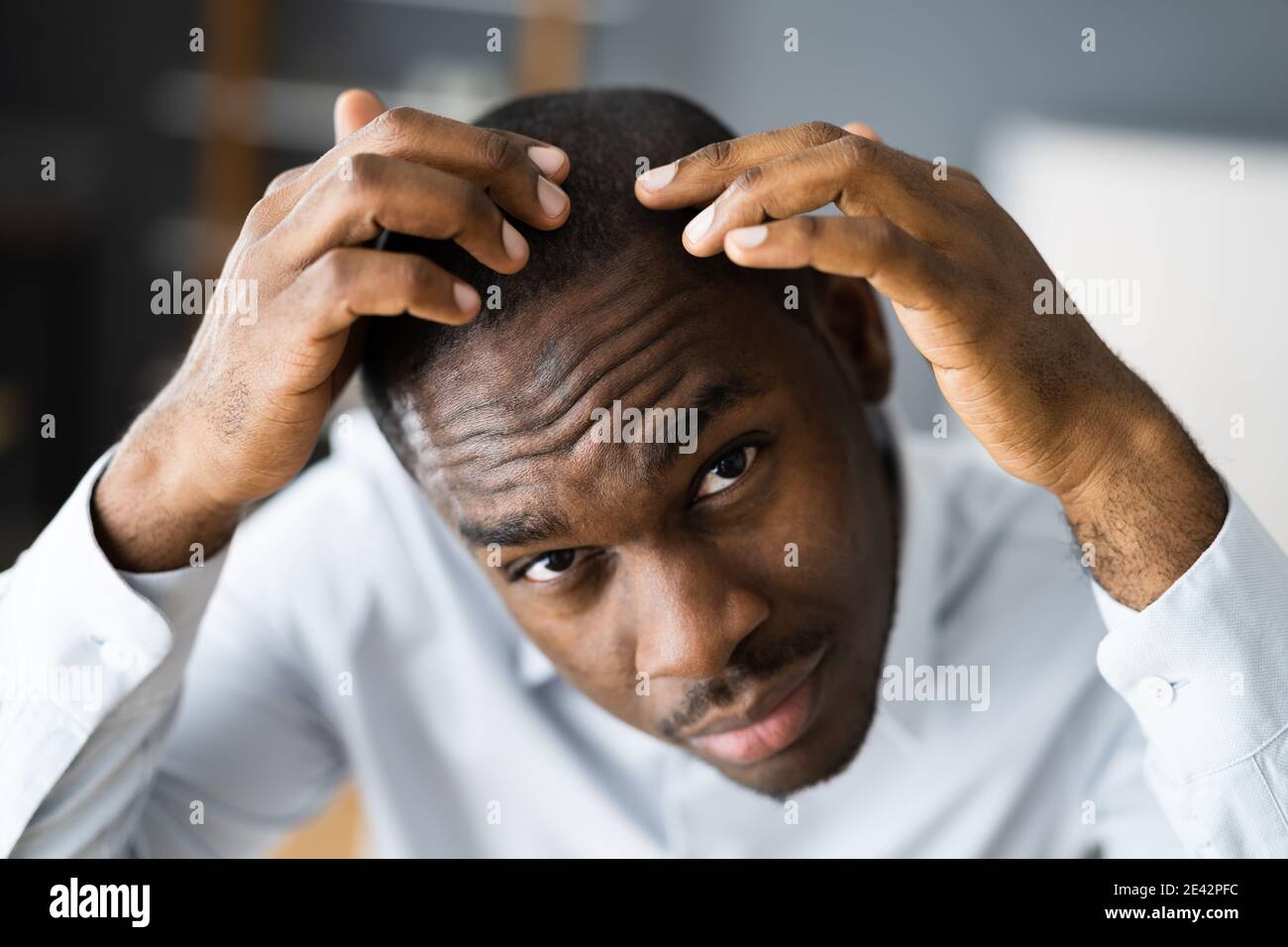 Junge Afrikanische Männer Haarausfall. Haarausfall Beobachten Stockfoto