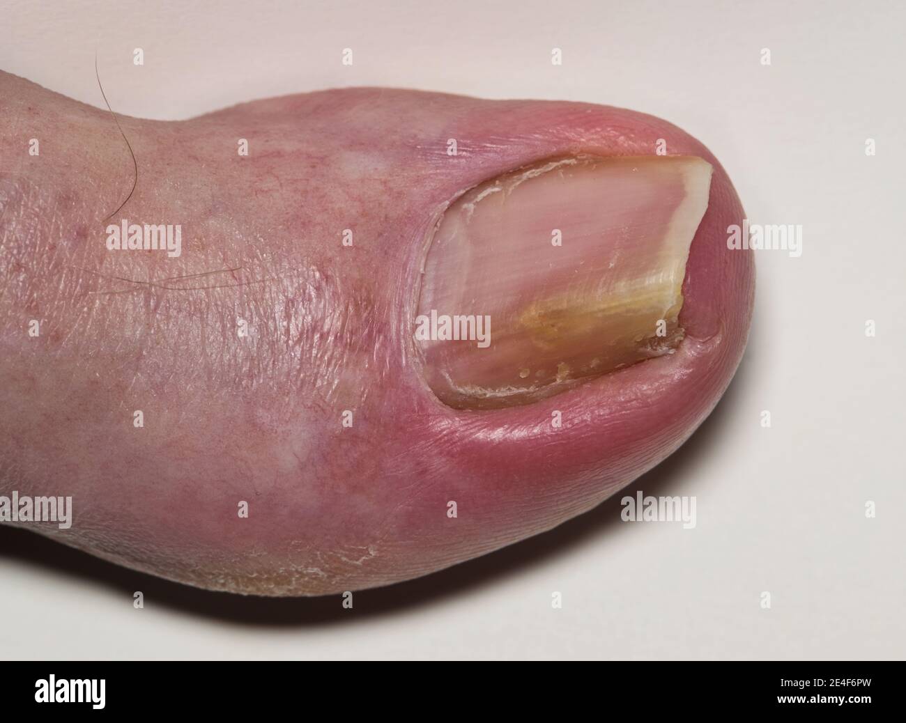 Eingewachsene Zehennagel Onychocryptosis auf kaukasischen Großzehe Hallux, verursacht durch Pilzinfektion Tinea unguium. Makro-Rückenansicht isoliert auf weißem Hintergrund Stockfoto