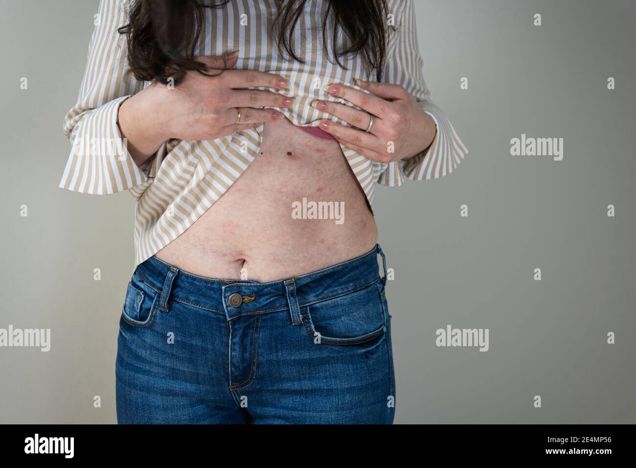 Frauen mit Symptomen von juckender Urtikaria oder allergischer Reaktion auf der Haut. Roter Hautausschlag auf den weiblichen Körper. Konzepte von Allergie, Hautkrankheiten und Gesundheit c Stockfoto