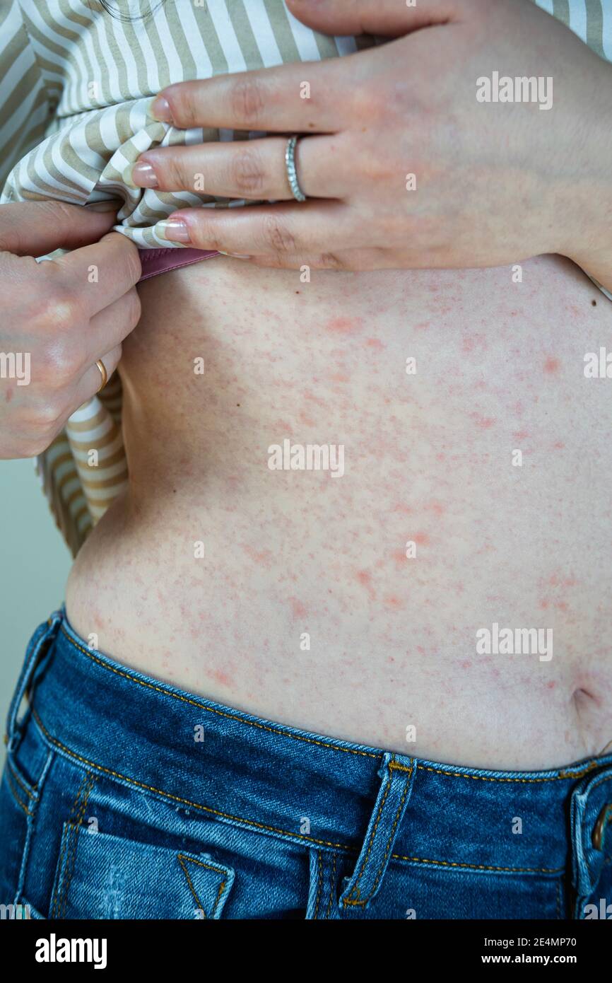 Frauen mit Symptomen von juckender Urtikaria oder allergischer Reaktion