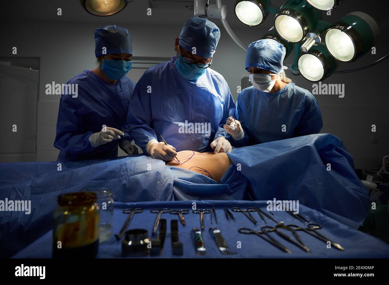Gruppe von Ärzten in sterilen Handschuhen und Schutzmasken tun kosmetische Chirurgie im Operationssaal im Krankenhaus. Patient mit Flecken auf dem Bauch, der auf dem Operationstisch liegt. Konzept der plastischen Chirurgie. Stockfoto