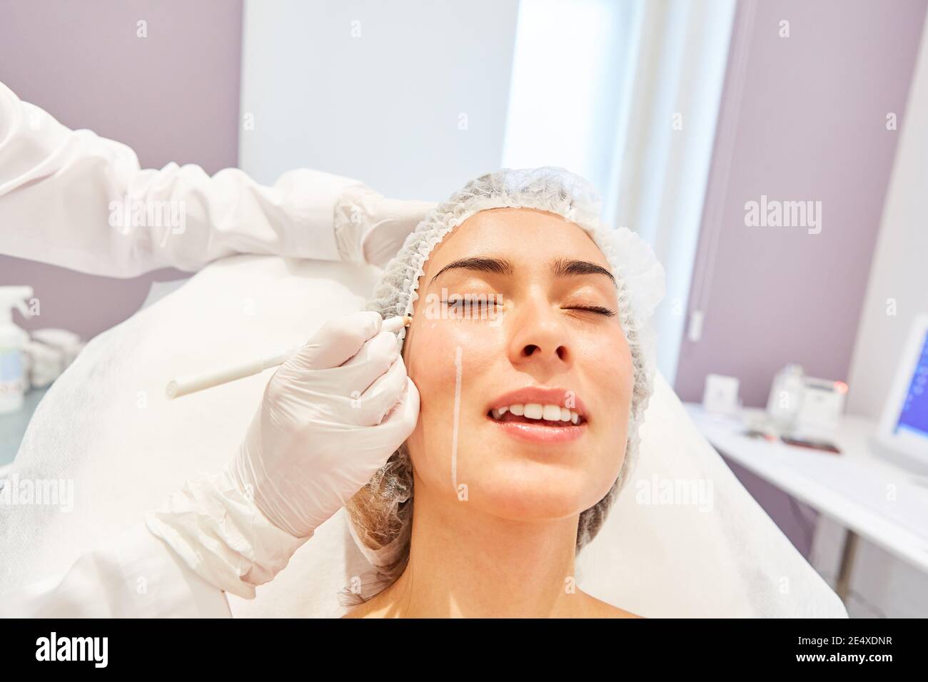 Der Arzt markiert die Gesichtshaut eines Patienten für die Faltenbehandlung Mit Hyaluronsäure Stockfoto