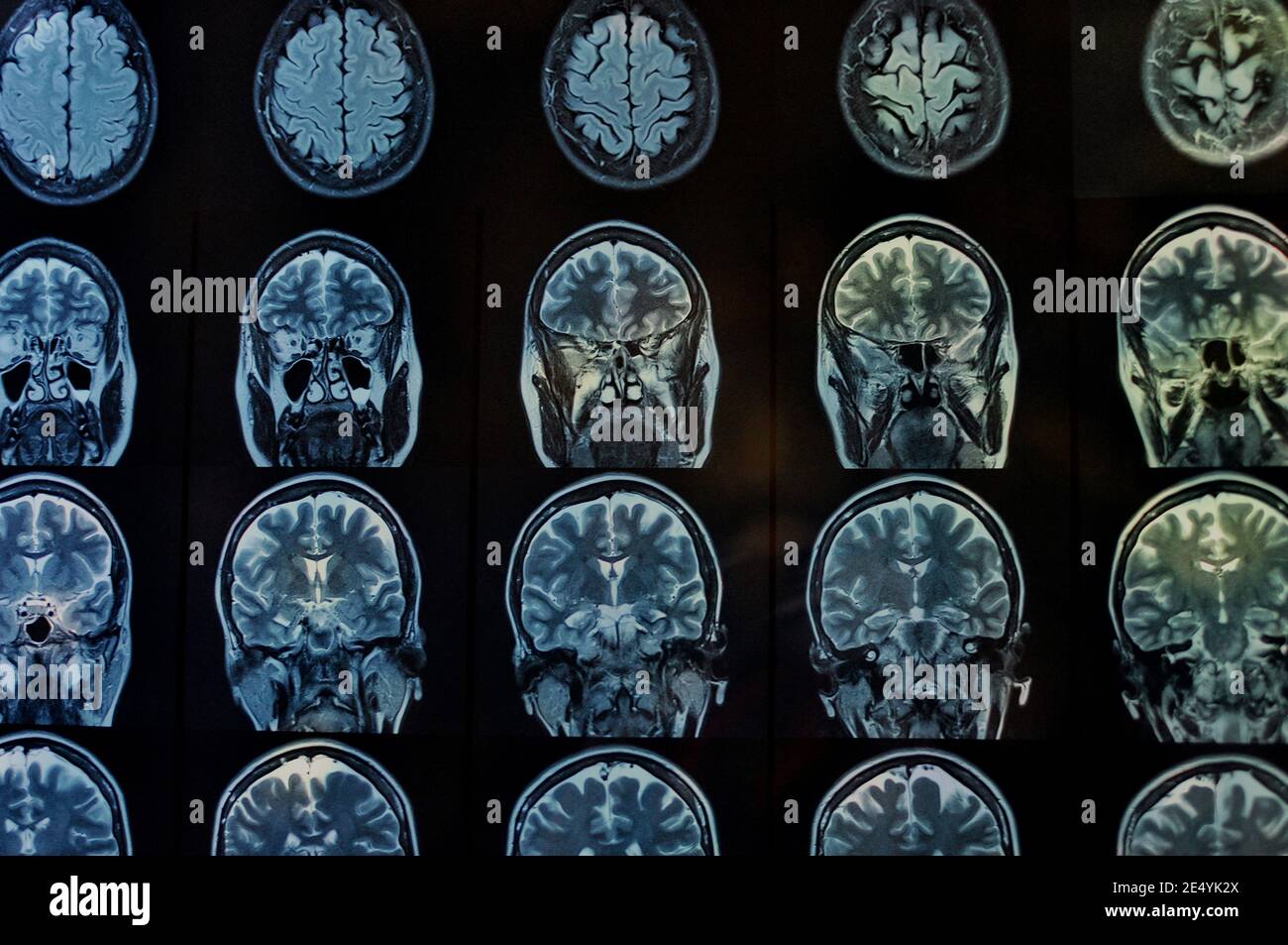 Magnetic Resonance Image Scan des Gehirns. Mrt-Film von einem menschlichen Schädel und Gehirn. Neurologie Hintergrund. Medizin, Wissenschaft, Vorderansicht Stockfoto