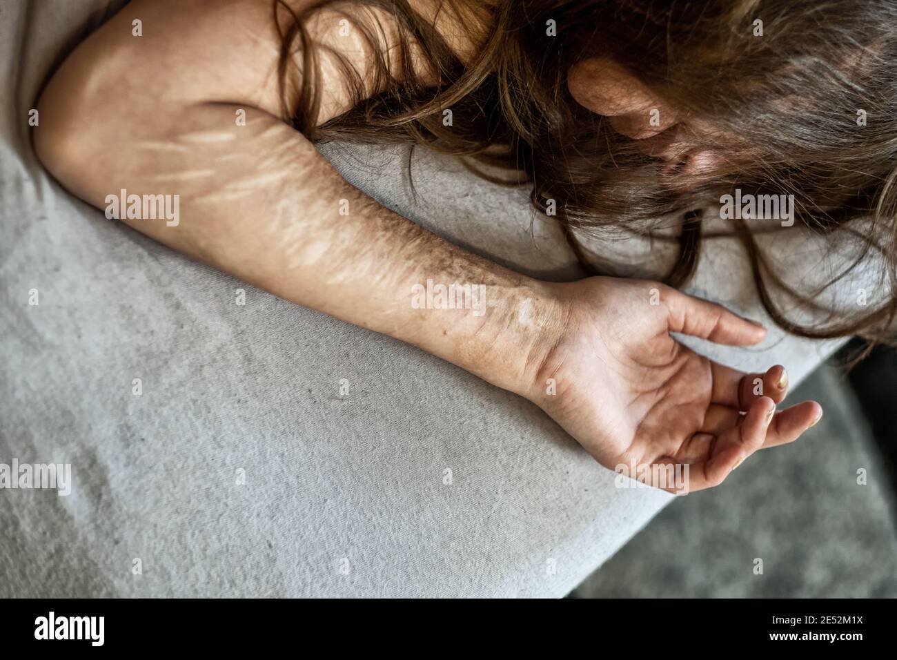 Hand, Arm und Haar einer Frau mit schweren Schnitten und Narben von Selbstverstümmelung in Frustration, Selbstmissbrauchs, Borderline-Persönlichkeitsstörung, Kopierraum Stockfoto