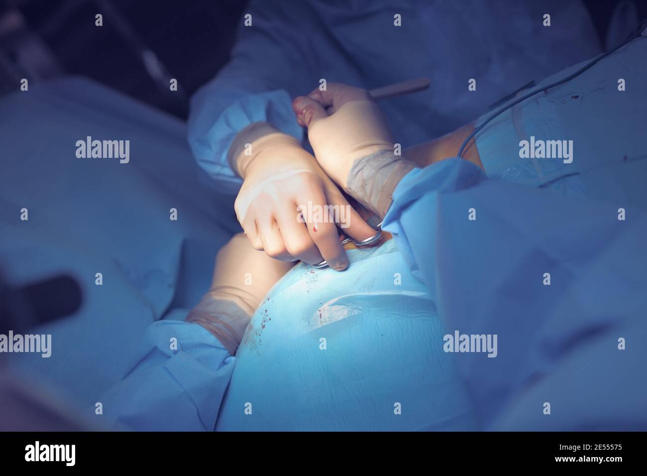 Gemeinsame Anstrengungen von zwei Chirurgen während des operativen Prozesses. Stockfoto