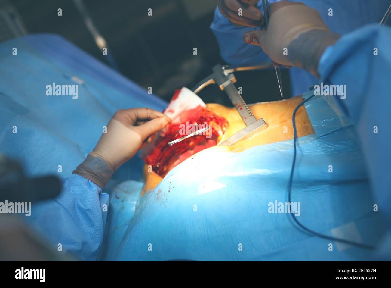 Team von Chirurgen, die einen chirurgischen Eingriff durchführen. Stockfoto