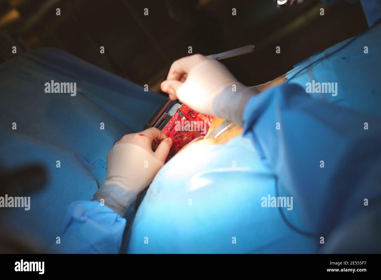 Hände des Chirurgen, die mit dem Operationsfeld arbeiten. Stockfoto