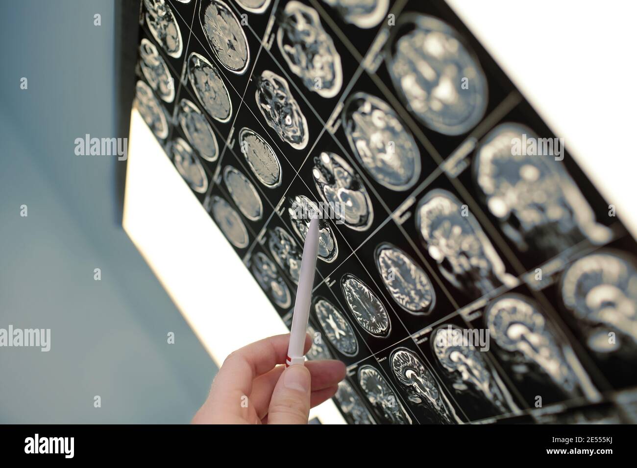 Arzt zeigt mit Stift auf der Hirnläsion. Stockfoto