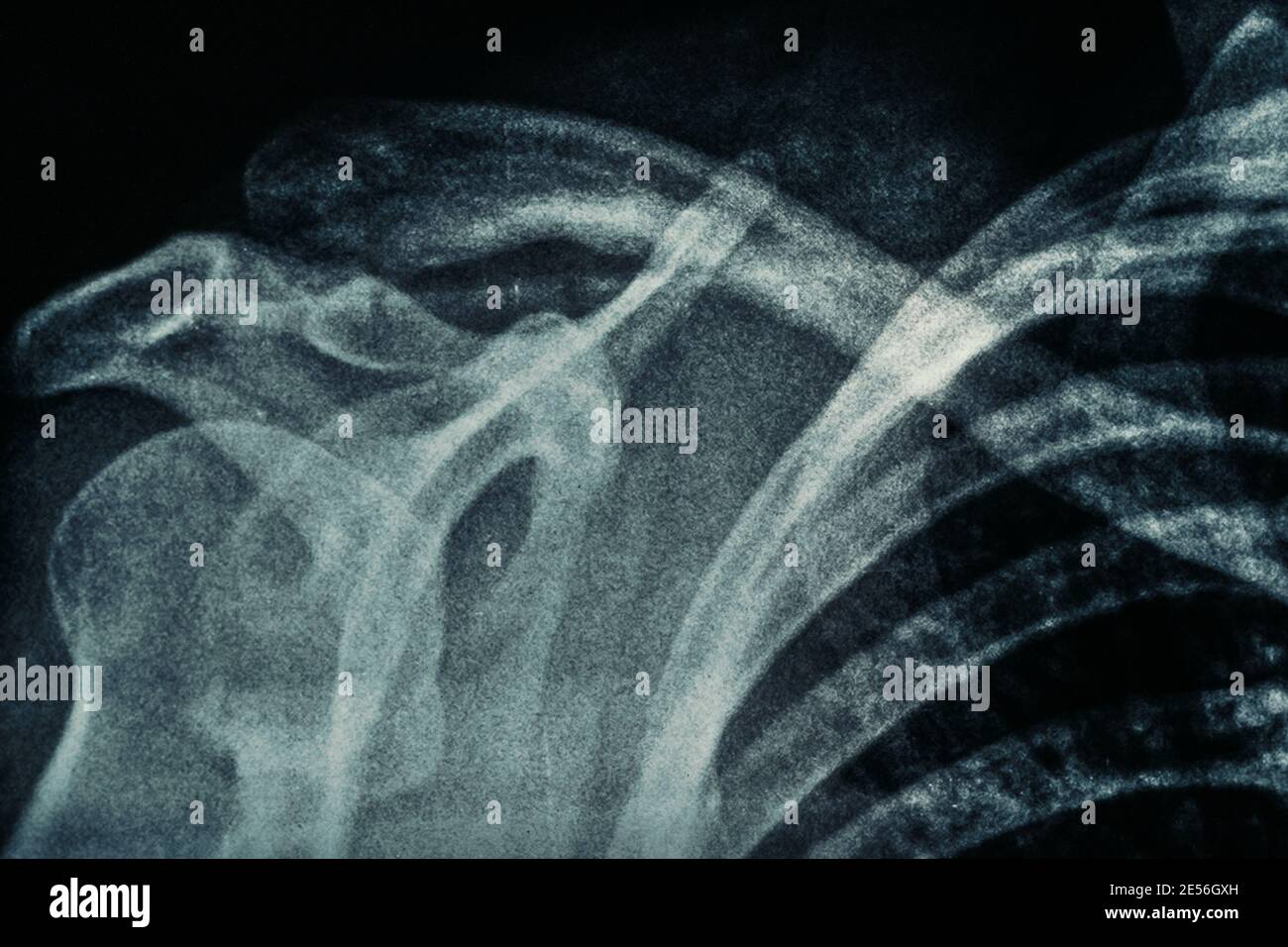 Makrofoto von echtem Röntgenfilm menschliche Schulter mit Filmkörnung. Stockfoto