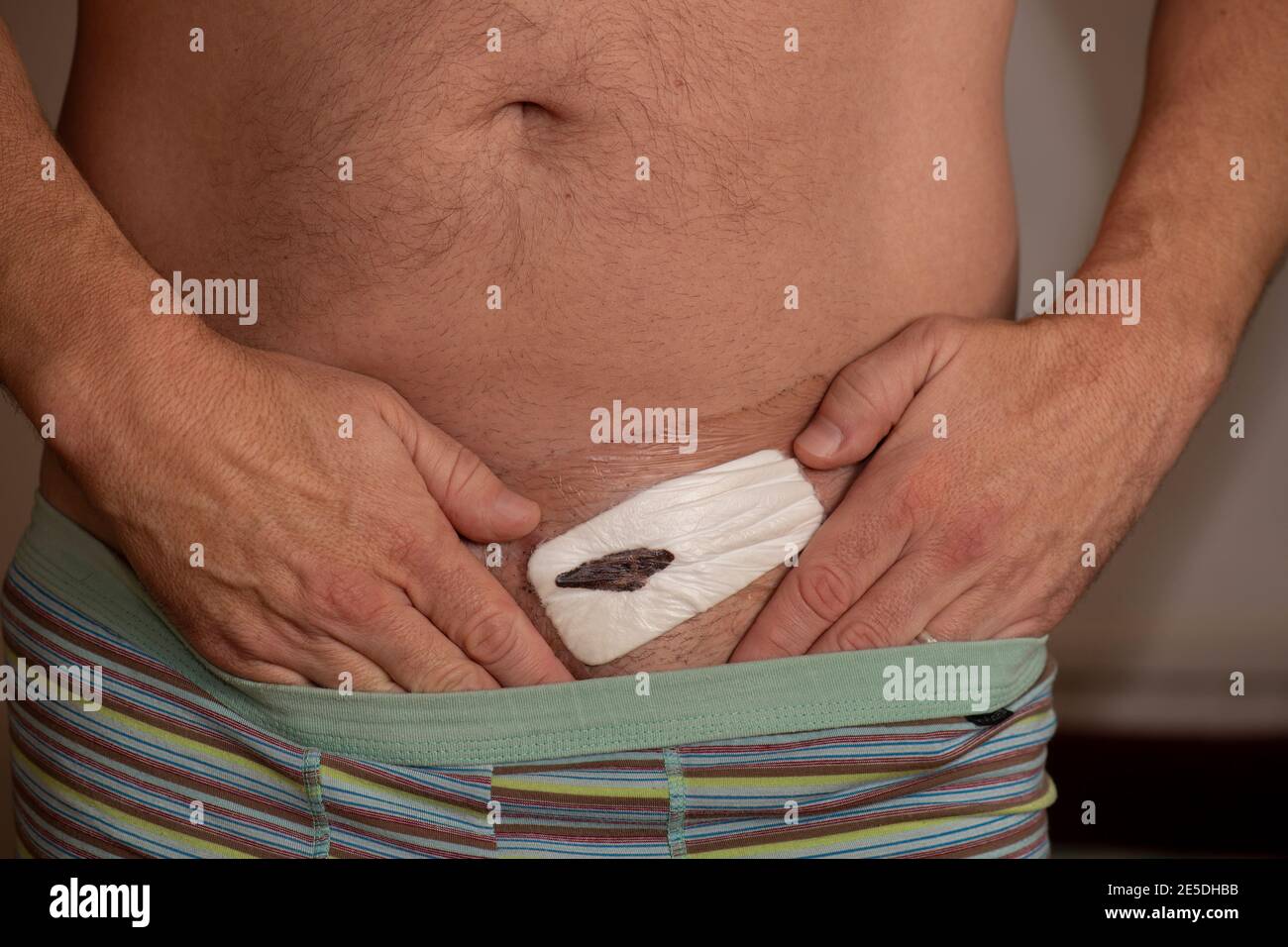 Herniennarbe, postoperative Leistenherniennarbe Stockfoto