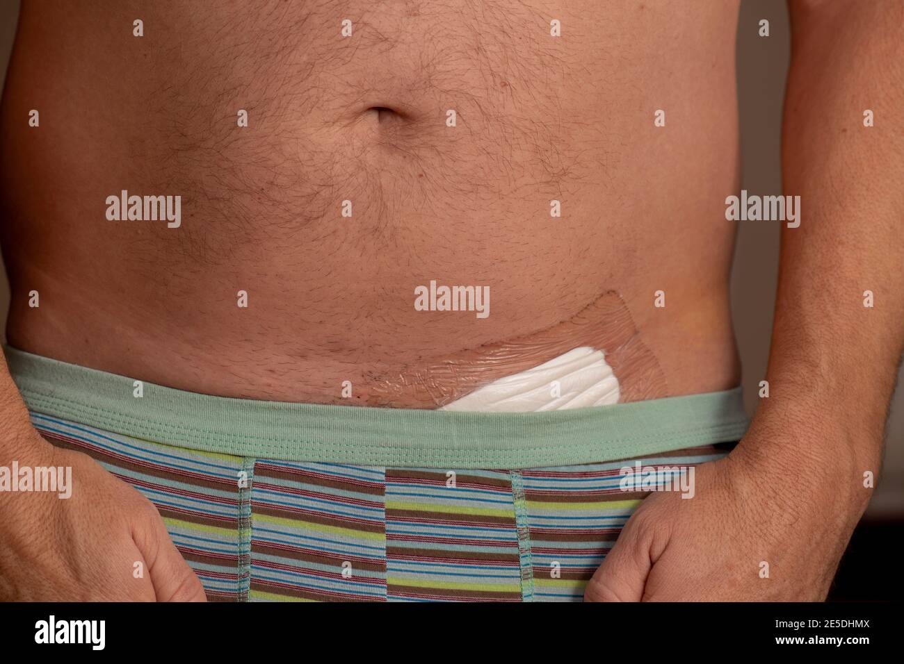 Herniennarbe, postoperative Leistenherniennarbe Stockfoto