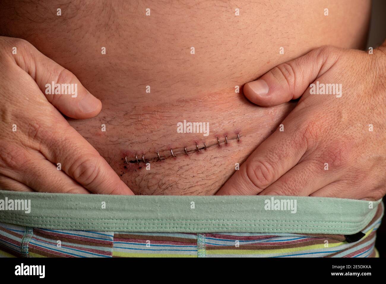 Herniennarbe, postoperative Leistenherniennarbe Stockfoto