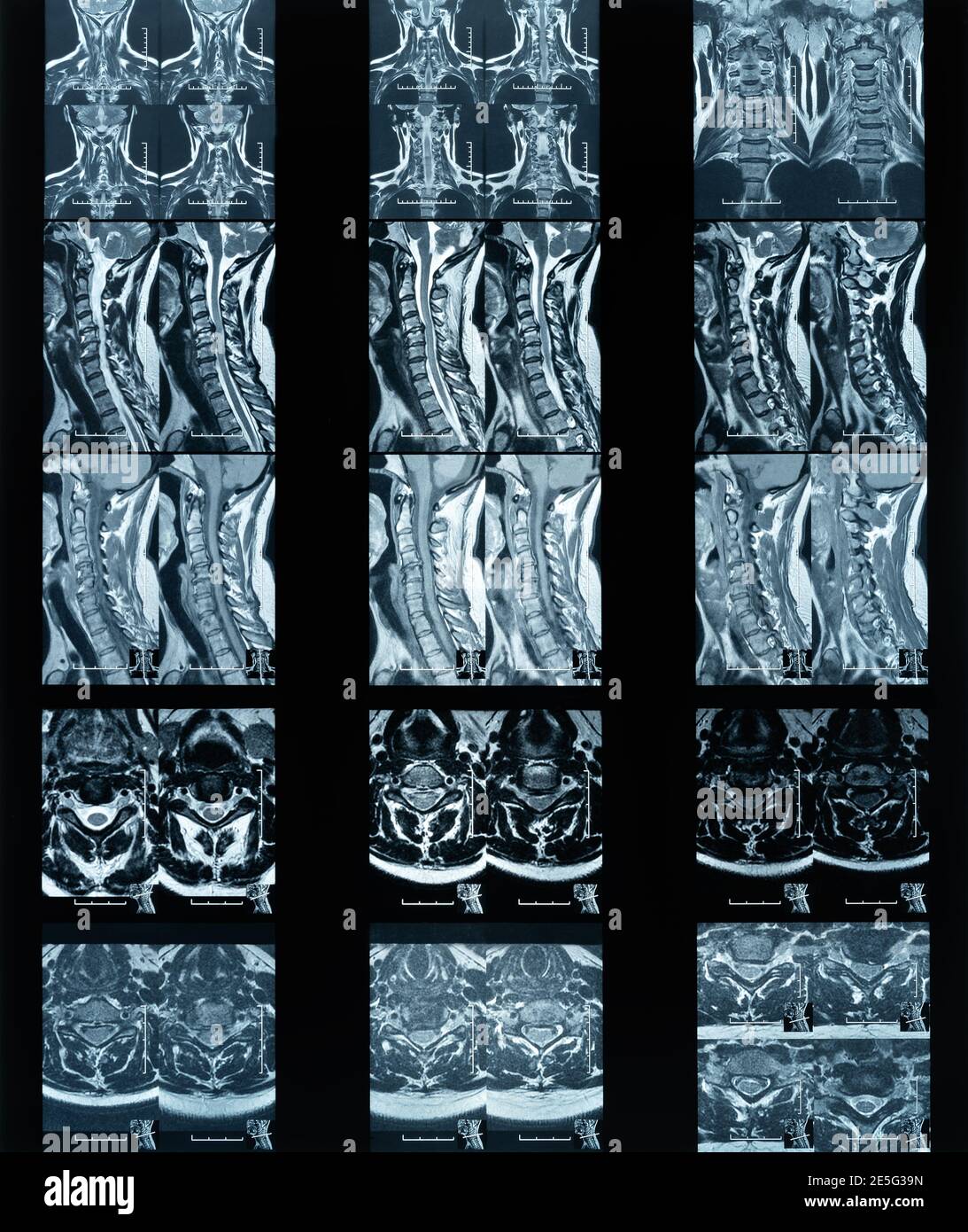 Magnetresonanztomographie Hals Bandscheibenvorfall Laborfilm Stockfoto