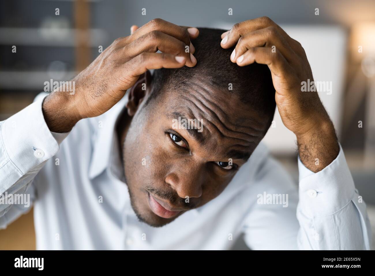 Junge Afrikanische Männer Haarausfall. Haarausfall Beobachten Stockfoto