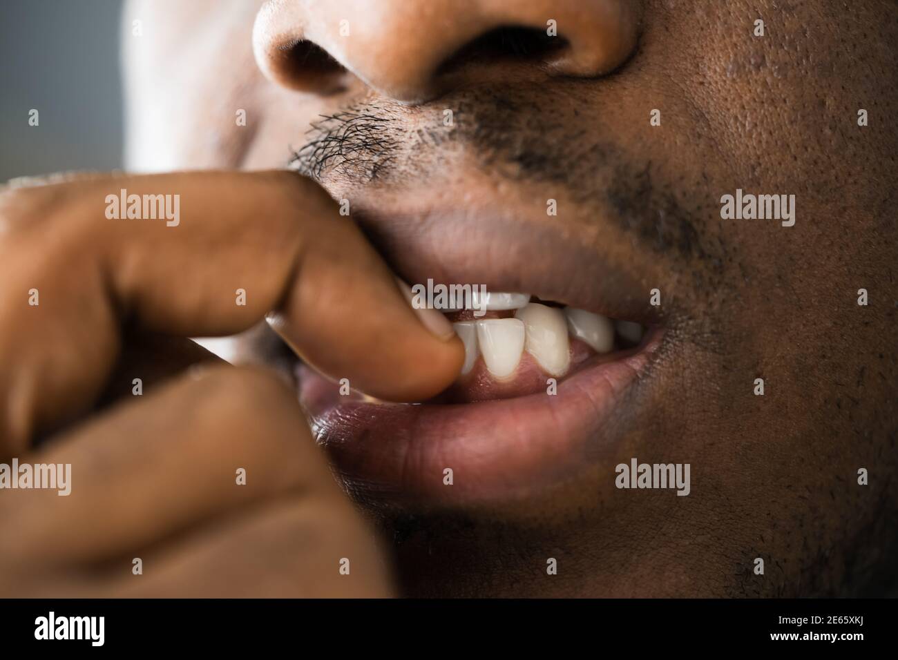 Neurotische Fingernagel Beißen Hände Und Mund Nahaufnahme Stockfoto