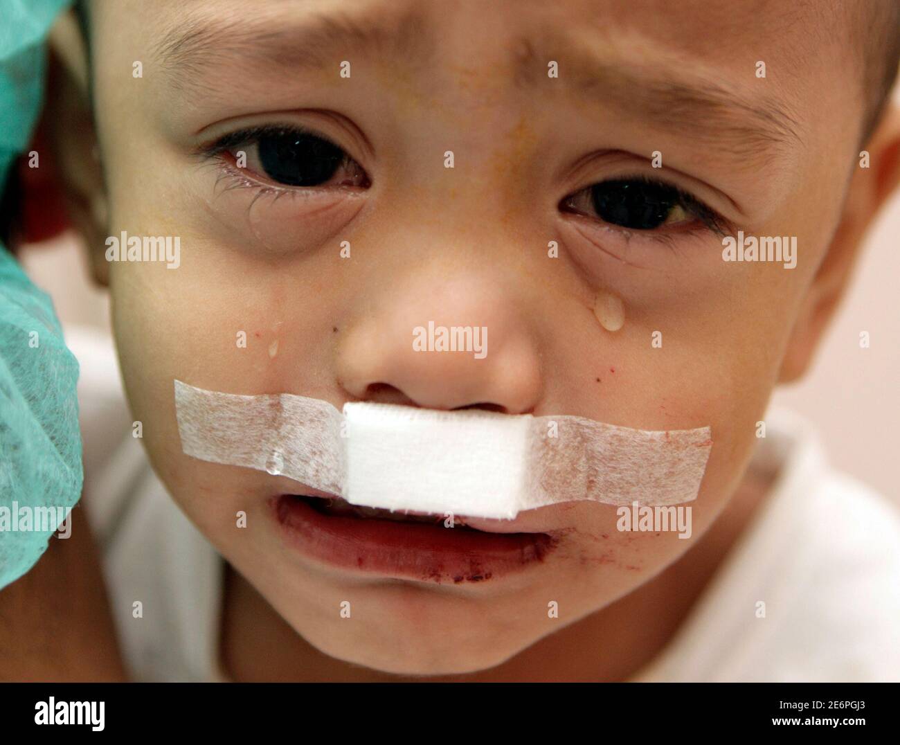 Ein Junge weint, als er sich nach einer Operation während der Operation Smile in einem Krankenhaus im Finanzbezirk Makati in Manila erholt 26. Oktober 2009. Operation Smile Ziel ist es, über einen Zeitraum von fünf Tagen in Makati rund hundert Kindern, die mit Lippen-, Gaumen- und anderen Gesichtsdeformitäten in Verbindung gebracht wurden, eine kostenlose Operation zu ermöglichen. REUTERS/CHERYL RAVELO (PHILIPPINISCHE GESUNDHEITSBILDER DER TAGESGESELLSCHAFT) Stockfoto