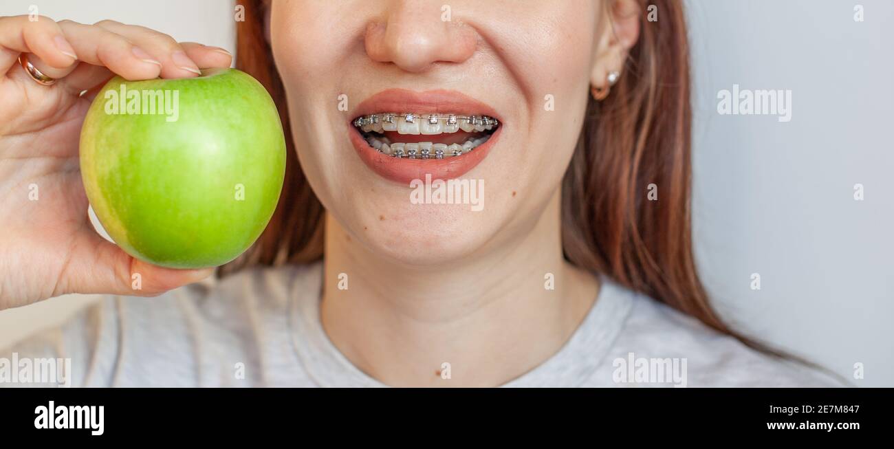 Ein Mädchen mit Zahnspangen will einen grünen Apfel beißen. Nahaufnahmen von Zähnen und Lippen. Glatte Zähne von Zahnspangen. Foto auf einem hellen soliden Rücken Stockfoto