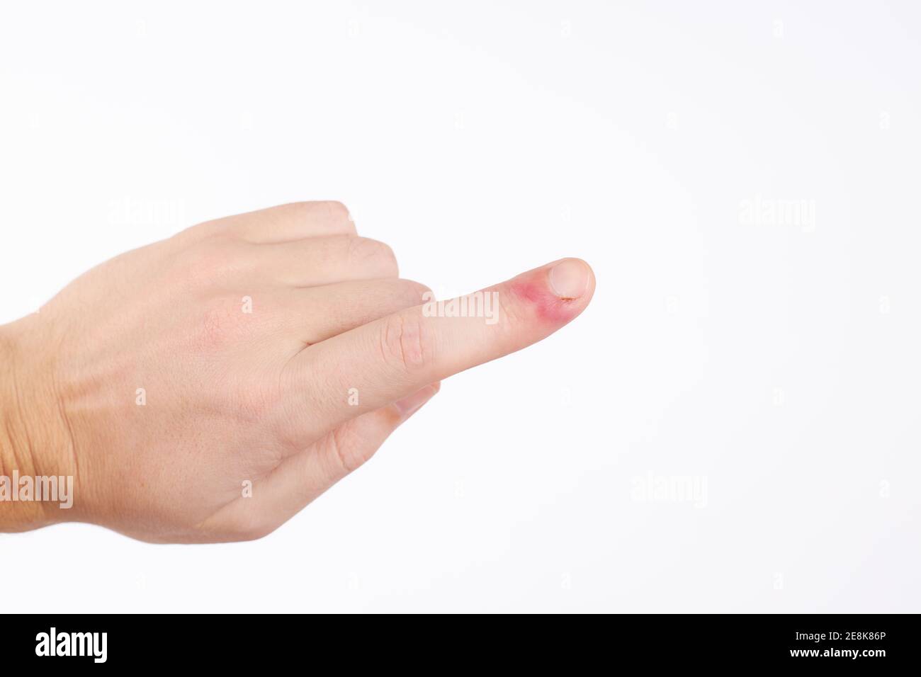 Person mit Finger-Infektion-Krankheit. Fingernagelschmerzen. Isoliert auf weißem Hintergrund. Copy Space Stockfoto
