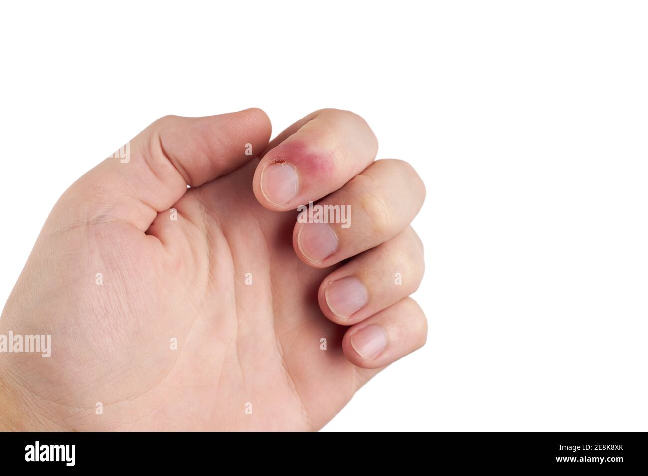 Person mit Finger-Infektion-Krankheit. Fingernagelschmerzen. Isoliert auf weißem Hintergrund. Copy Space Stockfoto