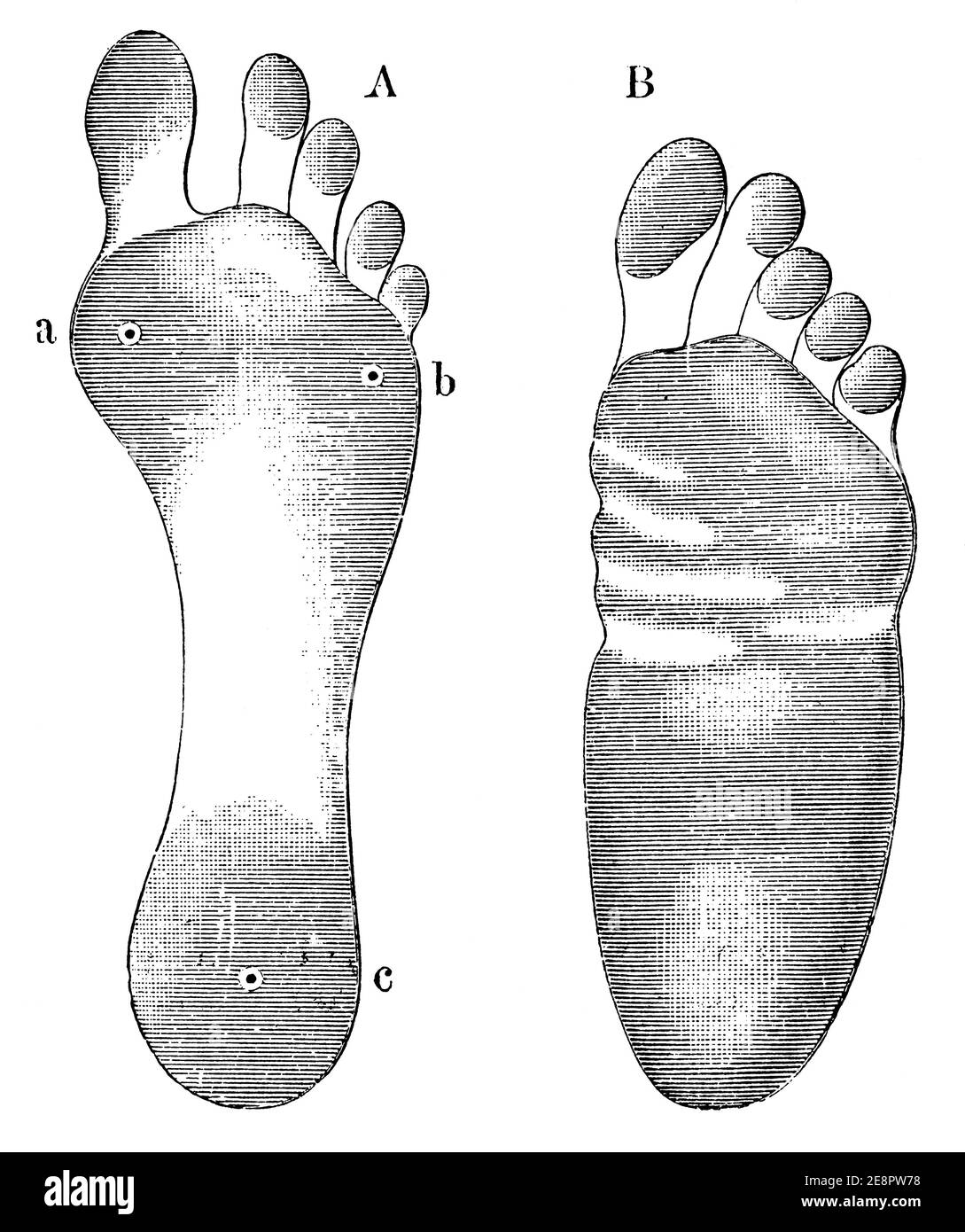 Ein Abdruck eines gesunden Fußes (links) und eines Fußes mit flachen Füßen (rechts). Illustration des 19. Jahrhunderts. Deutschland. Weißer Hintergrund. Stockfoto
