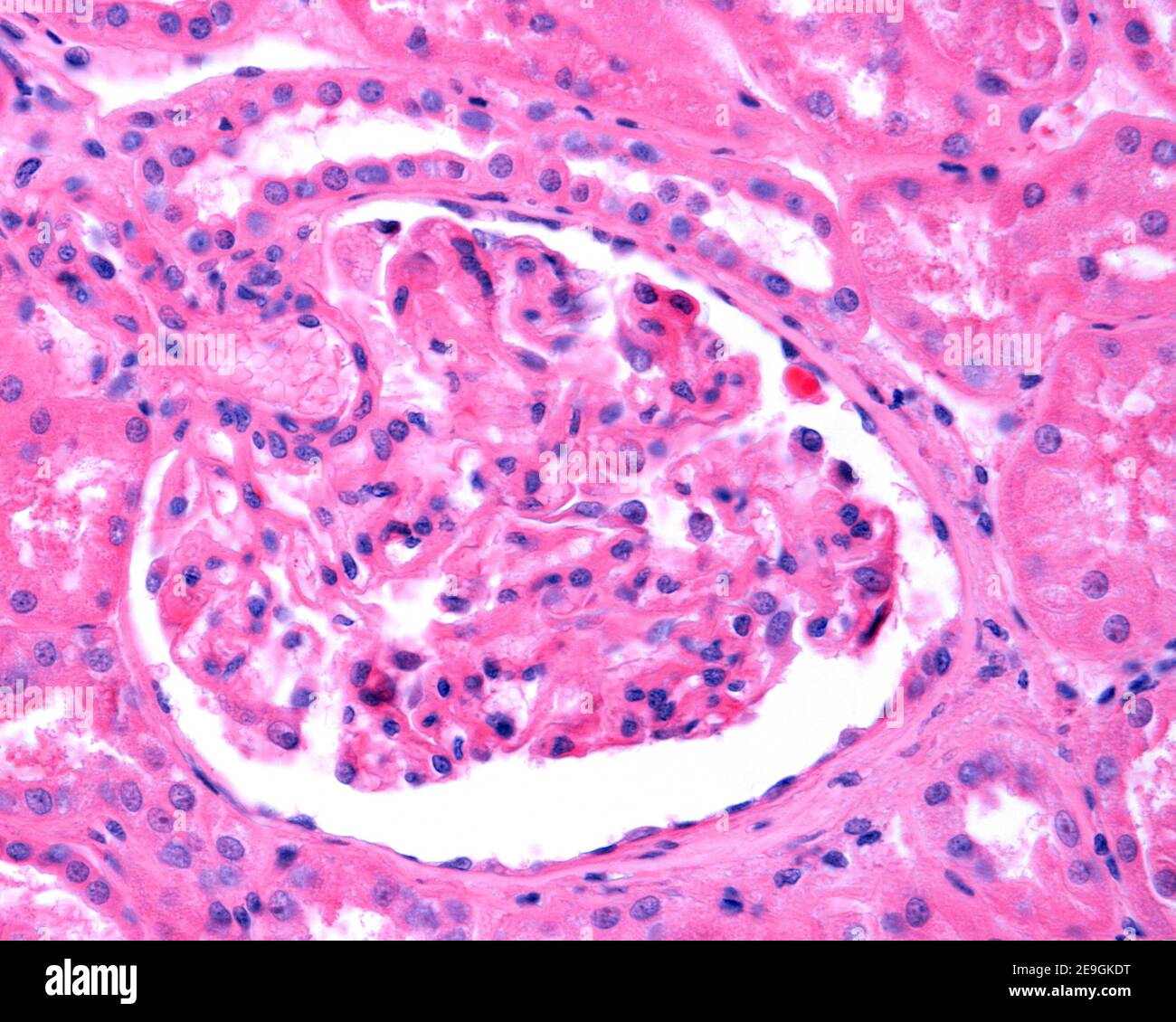 Nierenglomerulus durch eine membranöse Glomerulonephritis, die eine große Verdickung der Kapillarbasalmembranen zeigt betroffen. Stockfoto