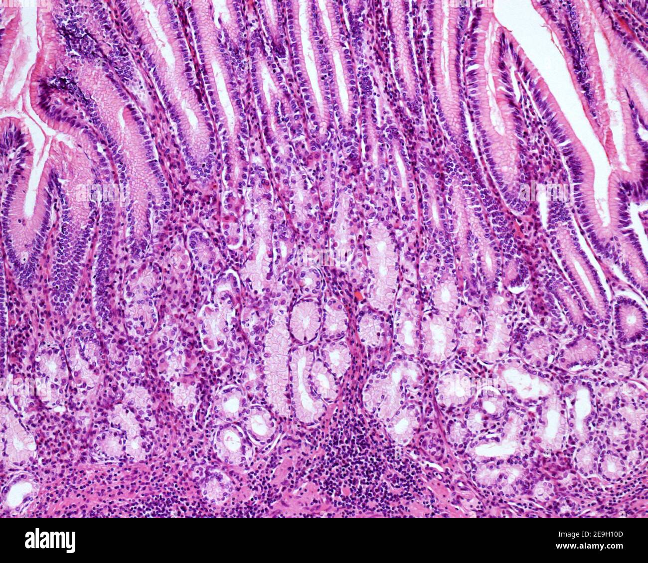 Tiefe Zone der pylorischen Magenschleimhaut. Es gibt sehr tiefe Magengruben und kurze Pylorusdrüsen, die von klaren Schleimzellen und Parietalzellen gebildet werden Stockfoto