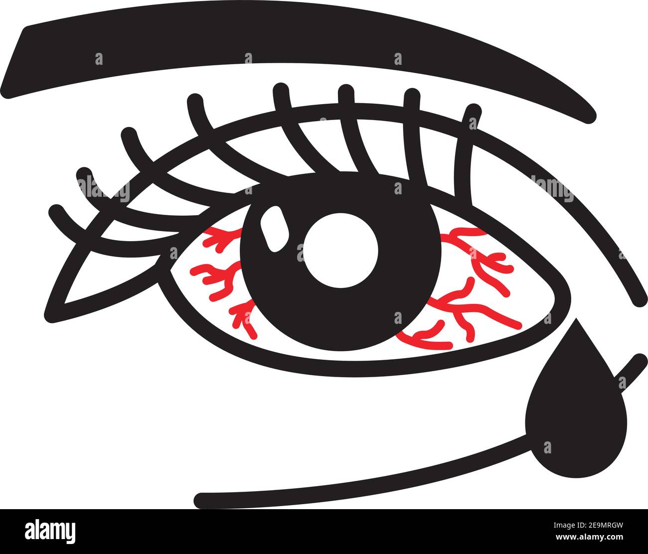 Entzündete Augenkonjunktivitis oder rosa Auge Stock Vektor