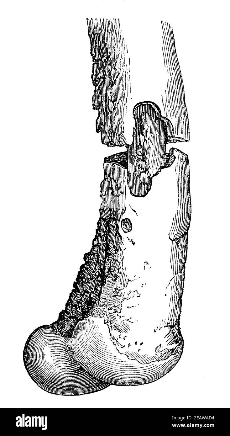 Totes Stück Knochen in lebenden Knochen. Illustration des 19th. Jahrhunderts. Deutschland. Weißer Hintergrund. Stockfoto