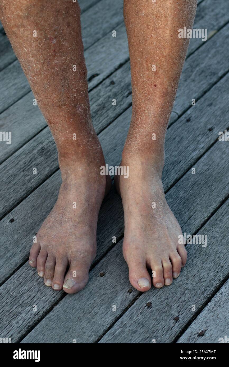 Alte Männerbeine mit schlechter Durchblutung und schlechter Gesundheit Stockfoto