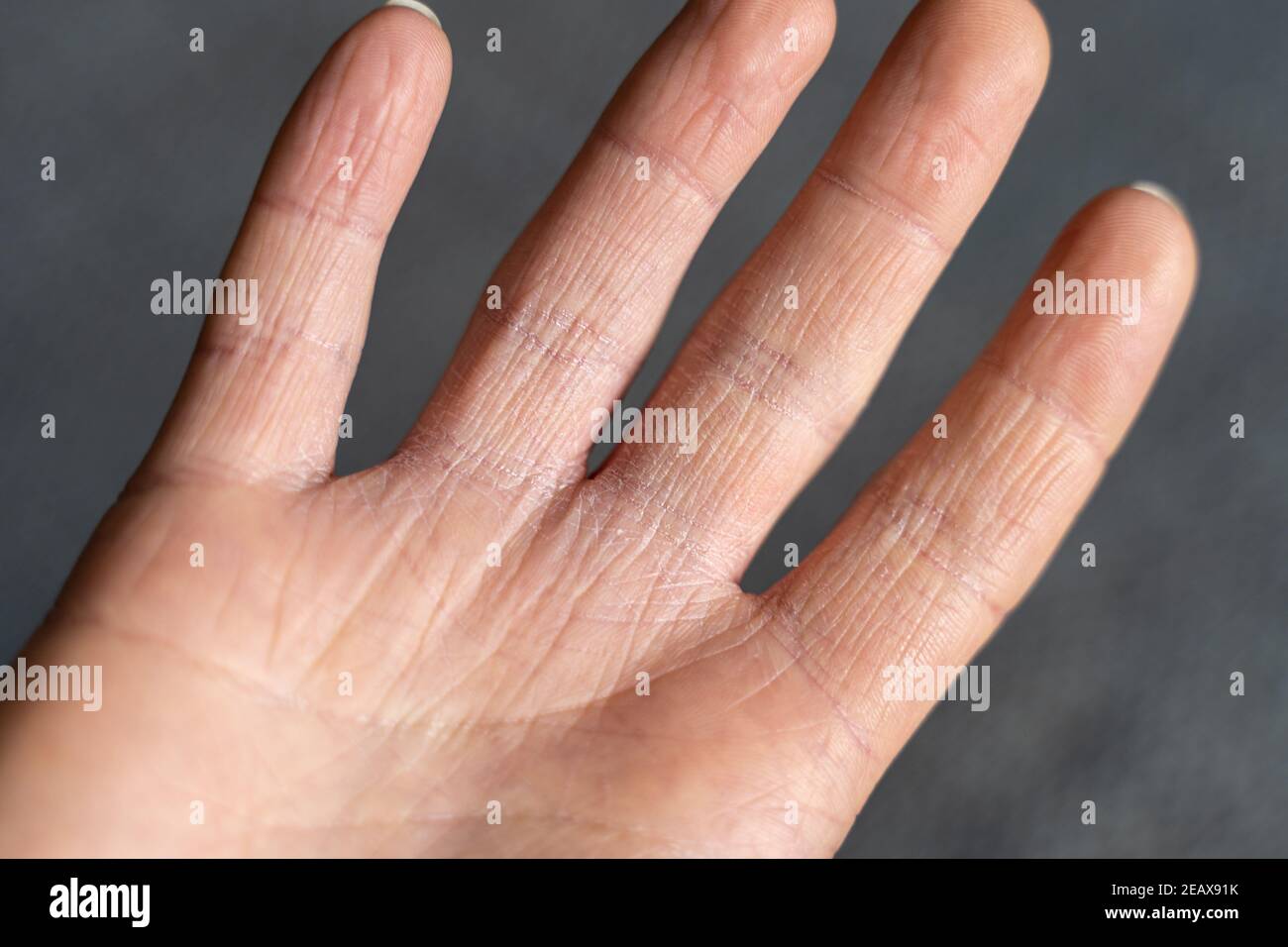 Keratosis pilaris an den Händen verursacht sehr trockene Haut während der Wintersaison. Handekzem braucht viel Pflege. Stockfoto