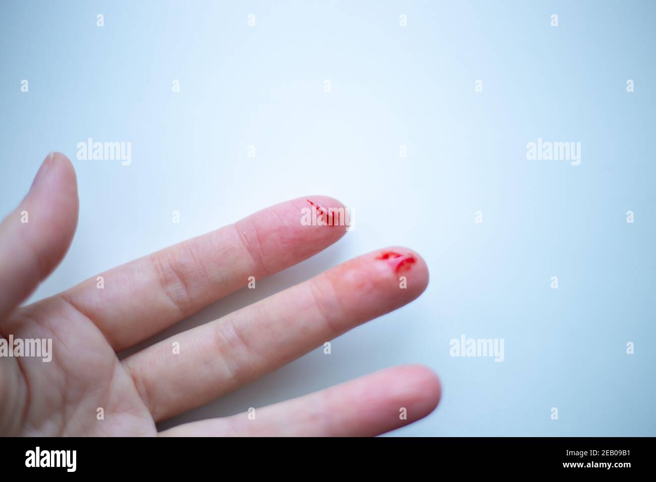 Blutige wunden an hand blutet Fotos und Bildmaterial in hoher Auflösung Alamy