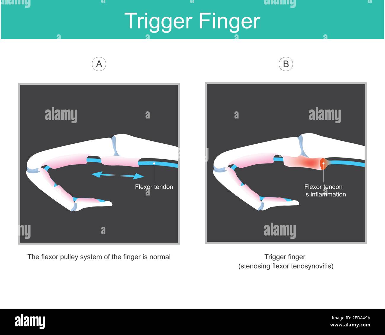 Trigger Finger. Illustration erklären ein Symptom der gesperrten Finger durch ein Problem mit der Sehne des menschlichen Fingers, die nicht in der Lage, Fi bewegen verursacht Stock Vektor
