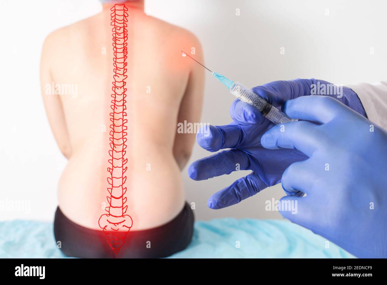 Der Arzt hält eine Spritze mit medizinischer Medizin vor dem Hintergrund  eines Patienten mit Rückenschmerzen. Konzept der medizinischen Behandlung  Blockade mit Ozon Stockfotografie - Alamy