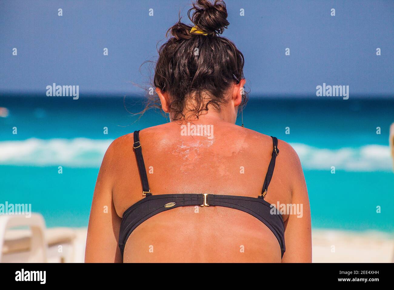 Frau mit Sonnenbrand zurück Stockfoto
