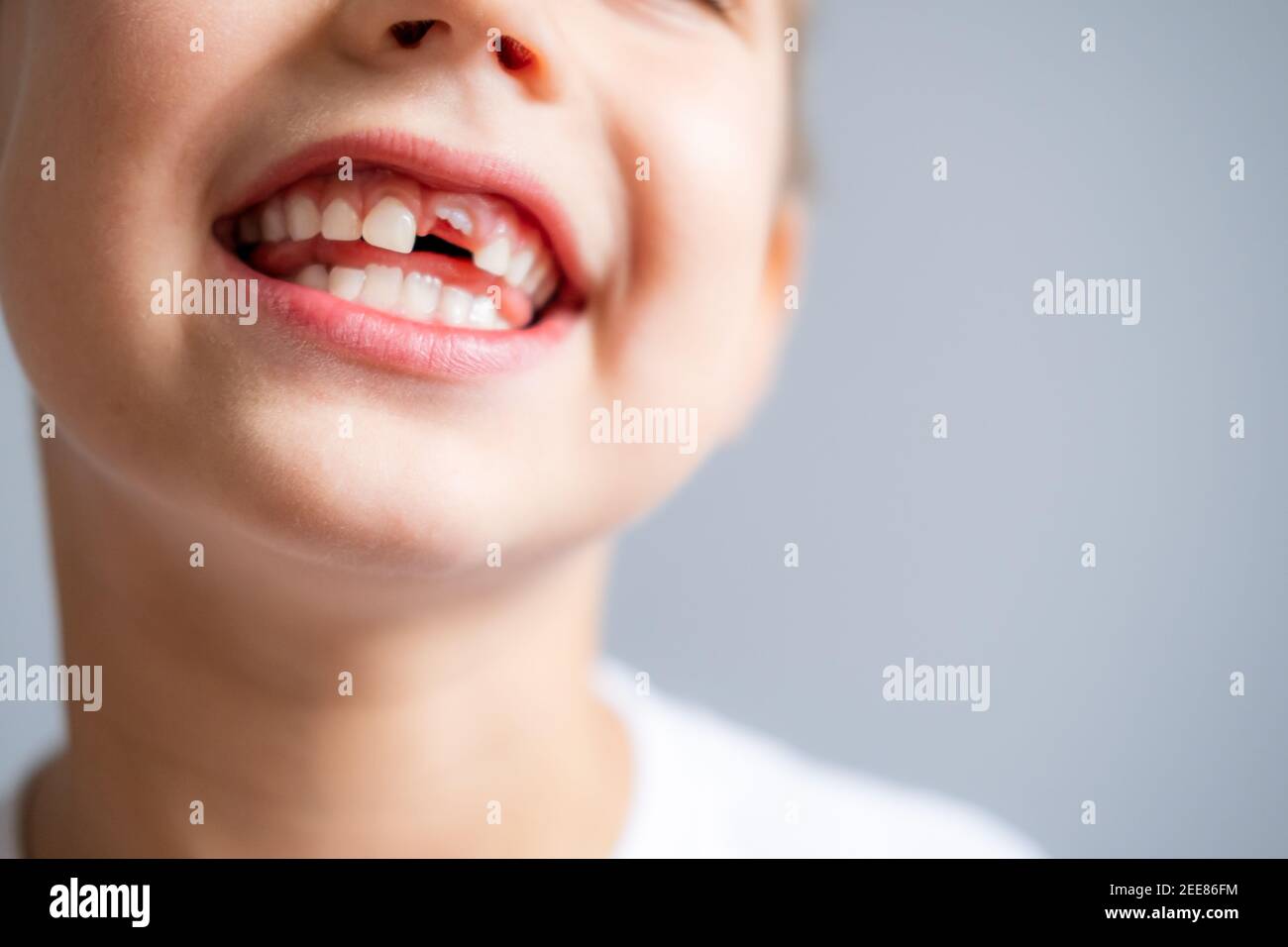 Junge ohne Milchzahn in weißem T-Shirt auf grauem Hintergrund. Nahaufnahme. Stockfoto