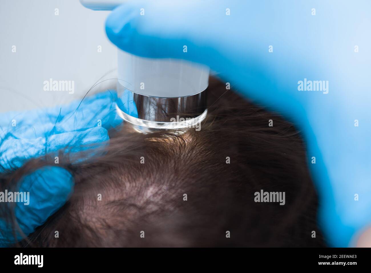 Untersuchung der Kopfhaut des Patienten mit einem Trichoskop. Trichoskopie der Haarfollikel. Stockfoto