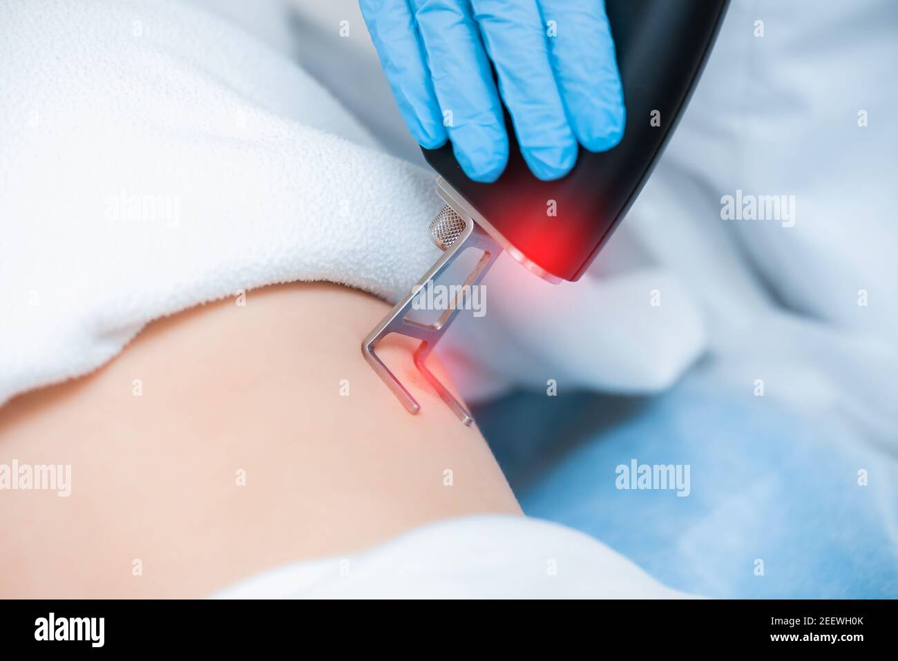 Nahaufnahme der Laser-Körper Narbe Entfernung Prozess. Moderner kosmetologischer Apparat. Stockfoto