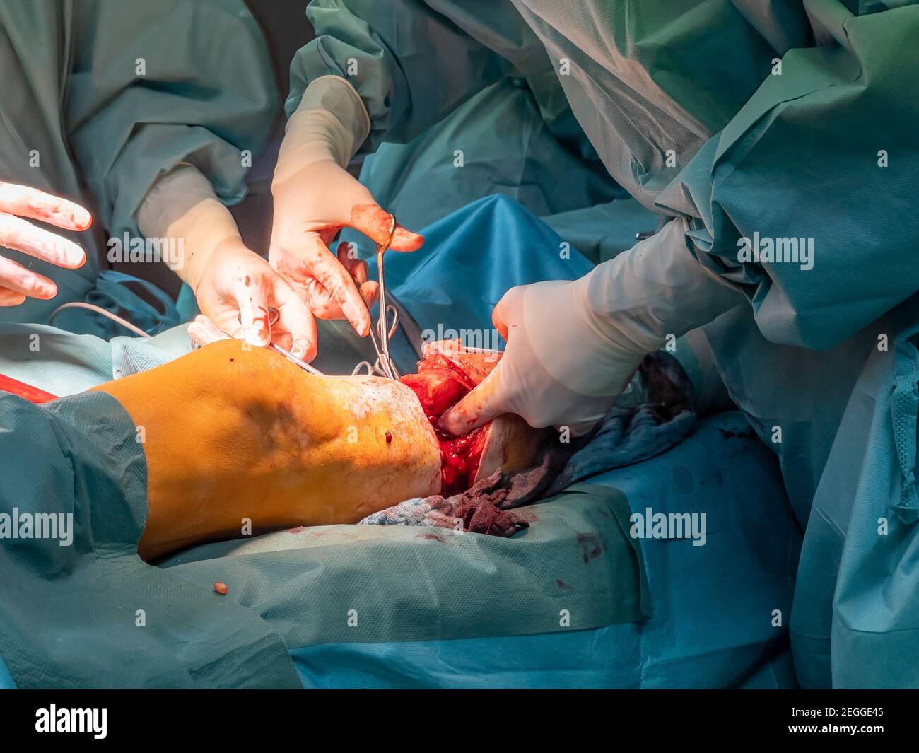 In einem Operationssaal wird eine Unterschenkelamputation durchgeführt Stockfoto