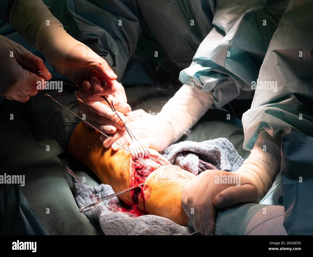 Amputation Stockfotos Und Bilder Kaufen Alamy