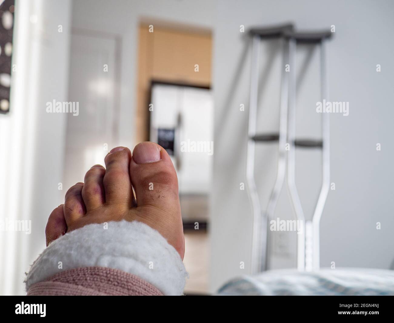 Geschwollene und gequetscht Zehen mit Krücken auf dem Hintergrund, Fuß hat einen elastischen Verband, Fuß Verstauchung Stockfoto